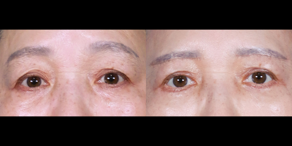 예스성형외과_전후사진_김숙자_눈썹하거상,하안검_한달경과_241104_예은.jpg