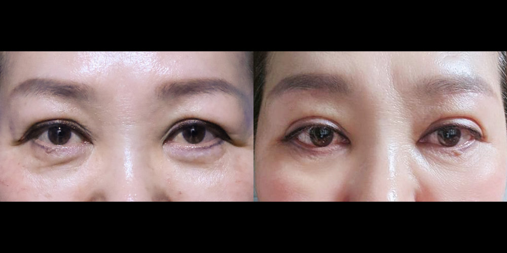 예스성형외과_전후사진_이현서_눈썹하거상_한달경과_241104_예은.jpg
