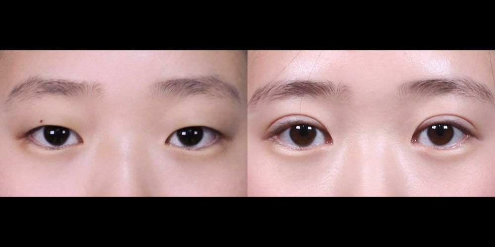 예스성형외과_전후사진_이현서_쌍꺼풀,앞트임_3달경과_241104_예은.jpg