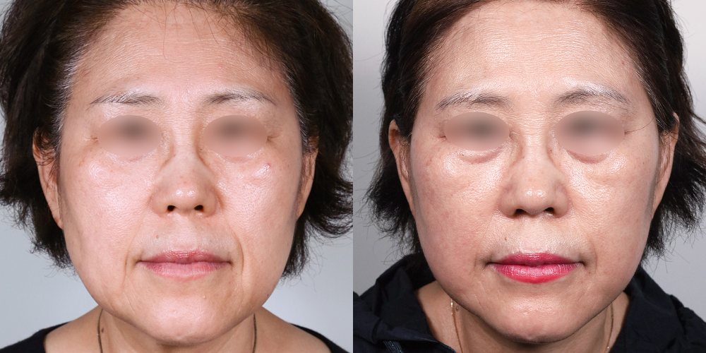 예스성형외과_전후사진_조인화_안면거상_한달경과_241104_예은.jpg