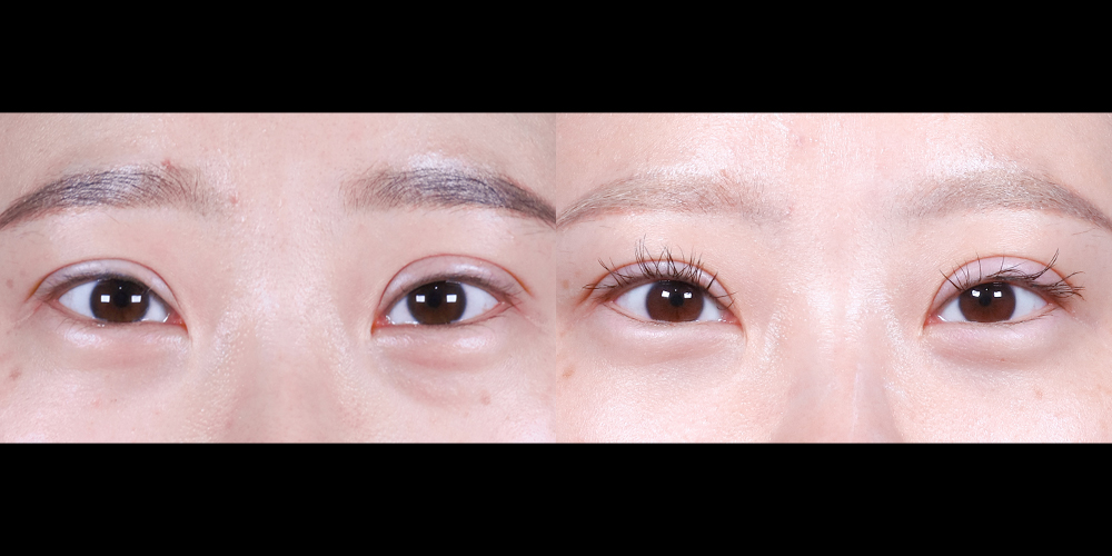 예스성형외과_전후사진_곽수민_눈안지방재배치_3달경과_241224_예은.jpg