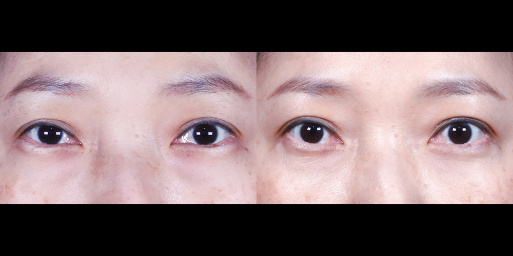 예스성형외과_전후사진_김명옥_하안검_한달경과_241224_예은.jpg