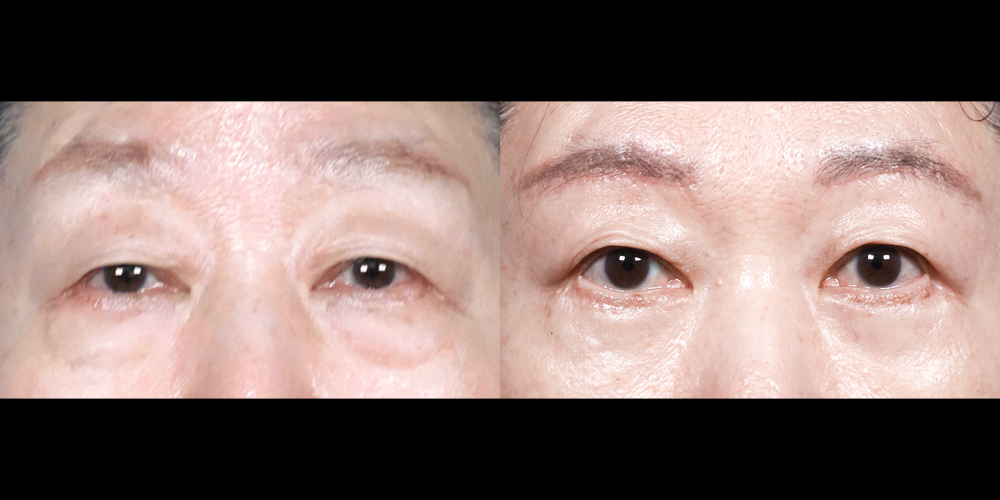 예스성형외과_전후사진_박옥화_눈썹하거상하안검_241224_예은.jpg