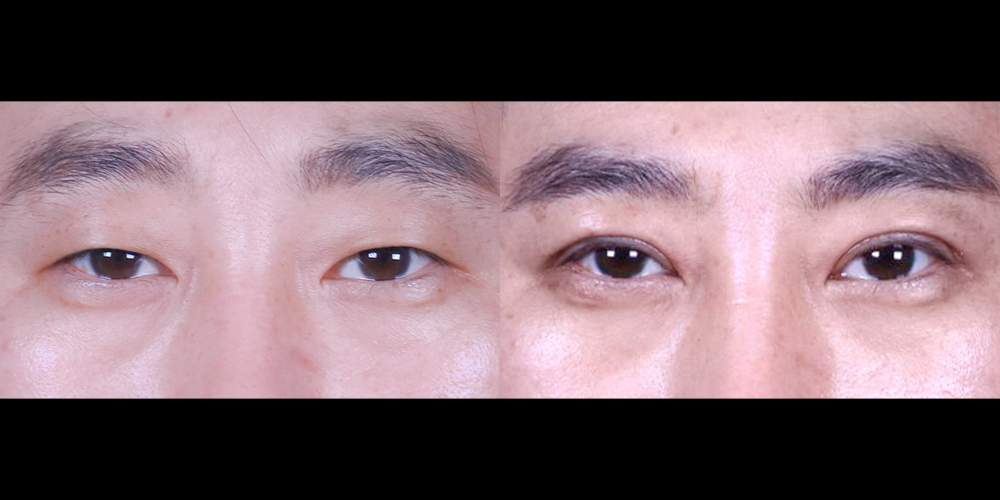 예스성형외과_전후사진_임성철_쌍꺼풀_실밥제거후_241224_예은.jpg