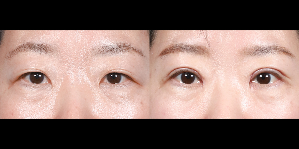 예스성형외과_전후사진_정문희_쌍꺼풀_한달경과_241224_예은.jpg