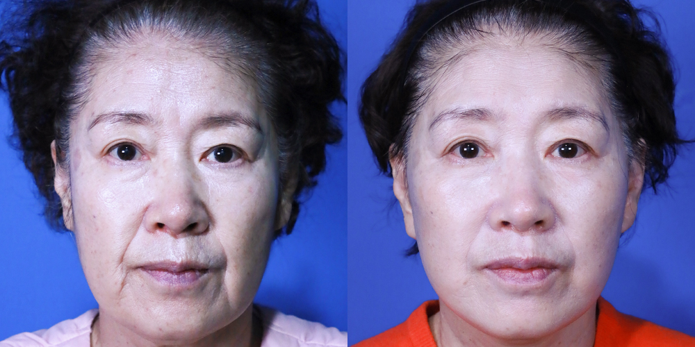 Bucheon Yes Plastic Surgery Before&After