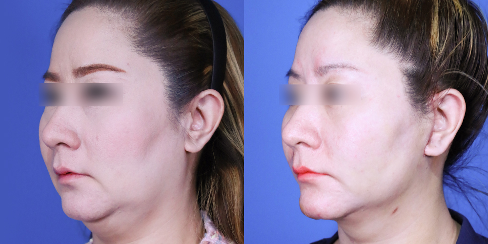 Bucheon Yes Plastic Surgery Before&After
