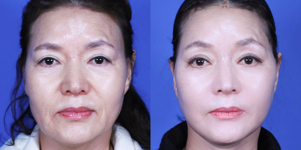 Bucheon Yes Plastic Surgery Before&After