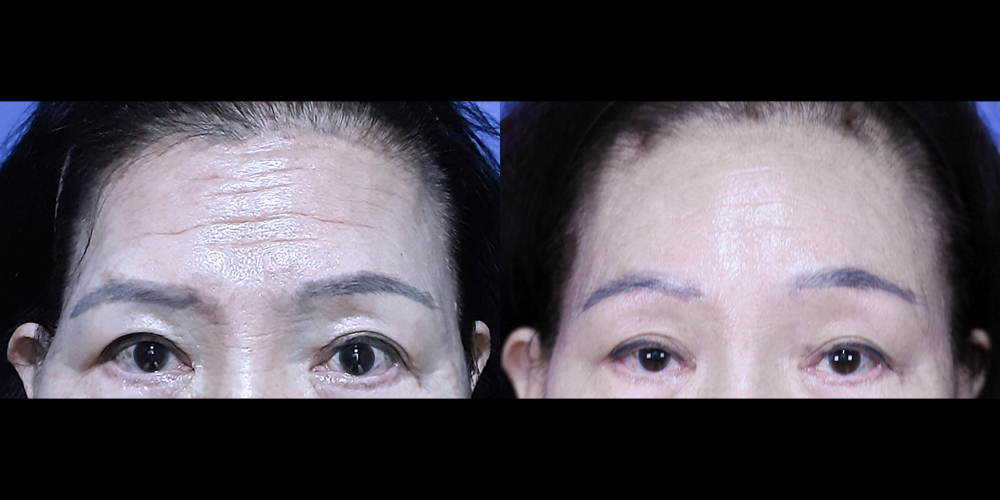 Bucheon Yes Plastic Surgery Before&After