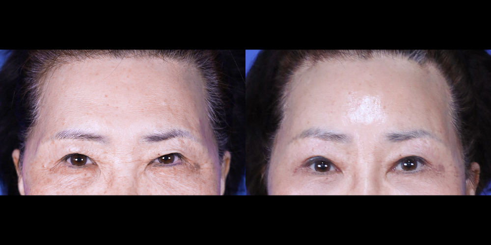 Bucheon Yes Plastic Surgery Before&After