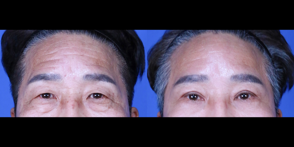 Bucheon Yes Plastic Surgery Before&After