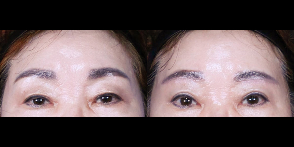 Bucheon Yes Plastic Surgery Before&After