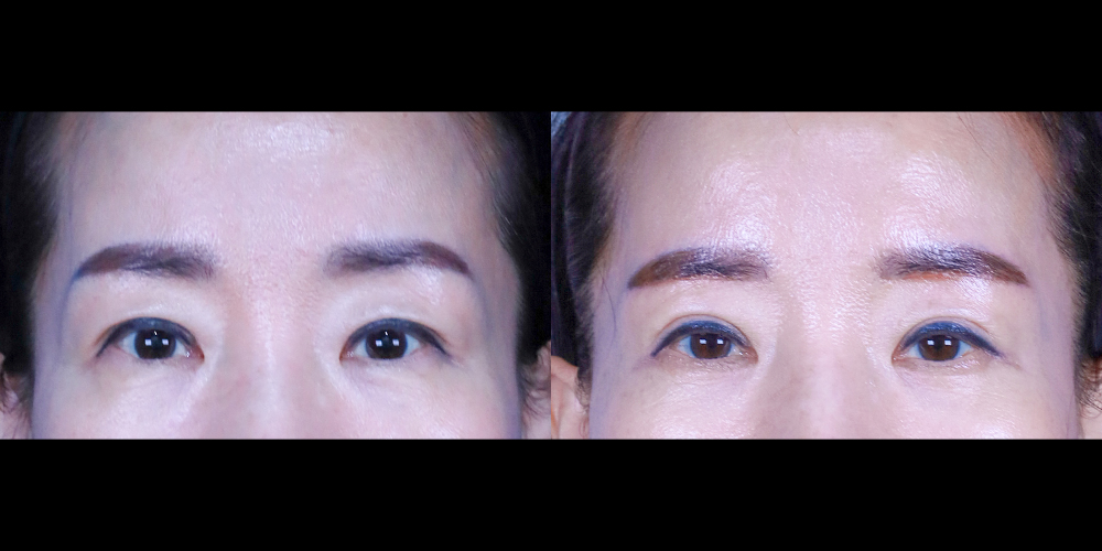 Bucheon Yes Plastic Surgery Before&After