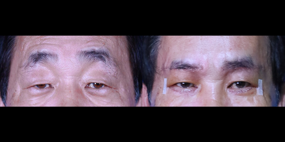 Bucheon Yes Plastic Surgery Before&After