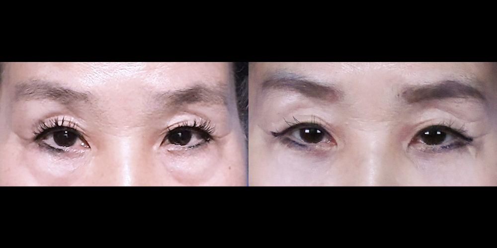 Bucheon Yes Plastic Surgery Before&After