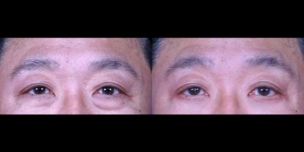 Bucheon Yes Plastic Surgery Before&After