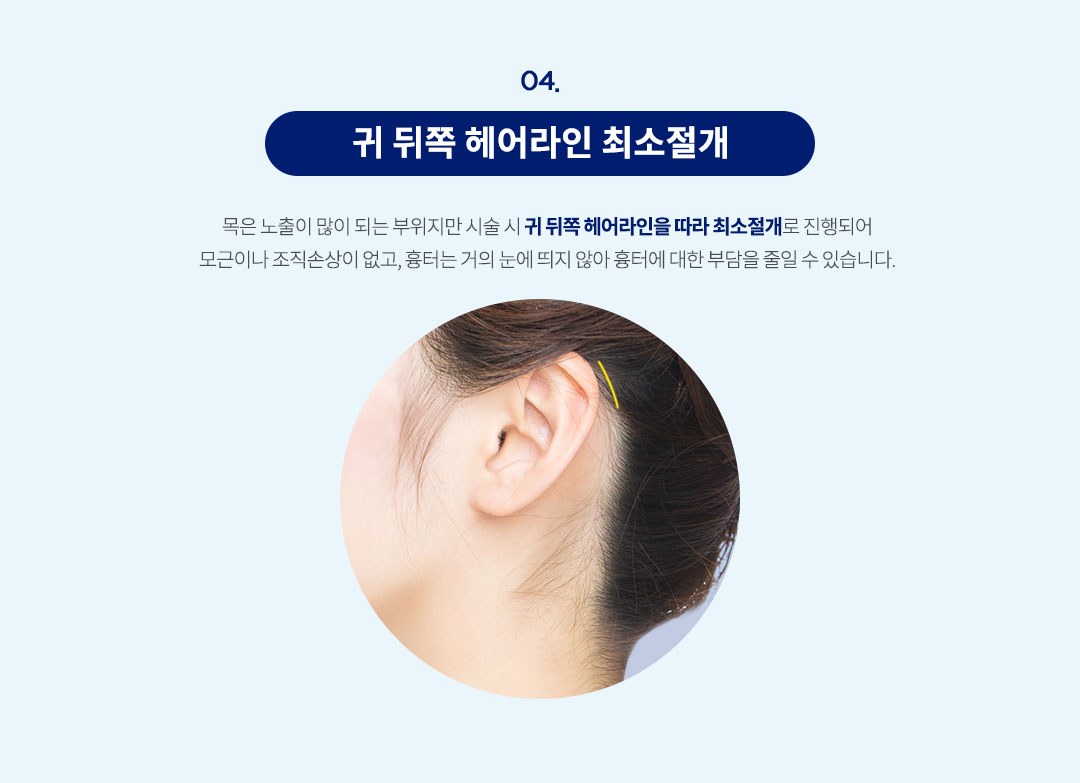 귀 뒤쪽 헤어라인 최소절개