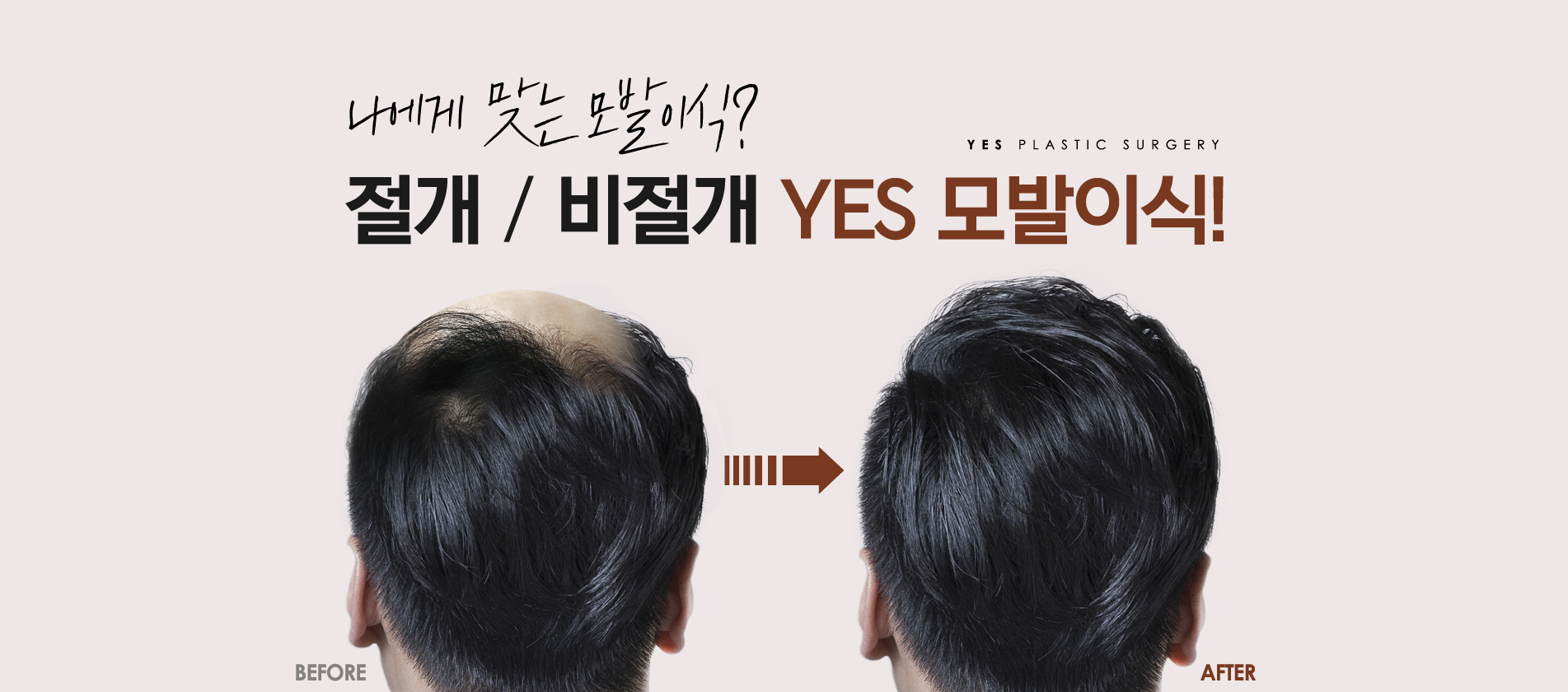 예스성형외과_메인슬라이드_241112_예은 (2).jpg